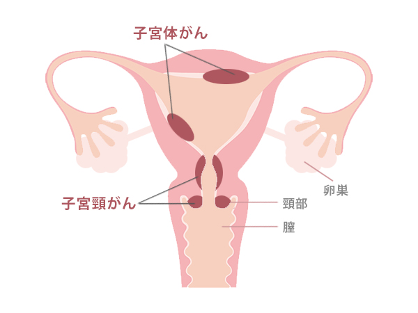 子宮 が ならない ん 頚 処女 子宮体がん検査を麻酔で受けていますが、友人に笑われました