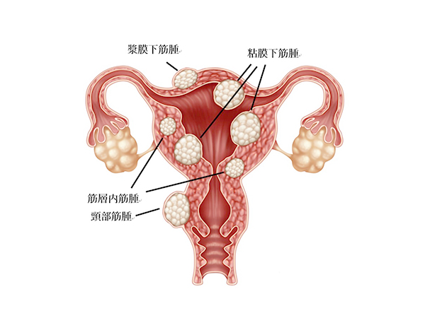 子宮 筋腫
